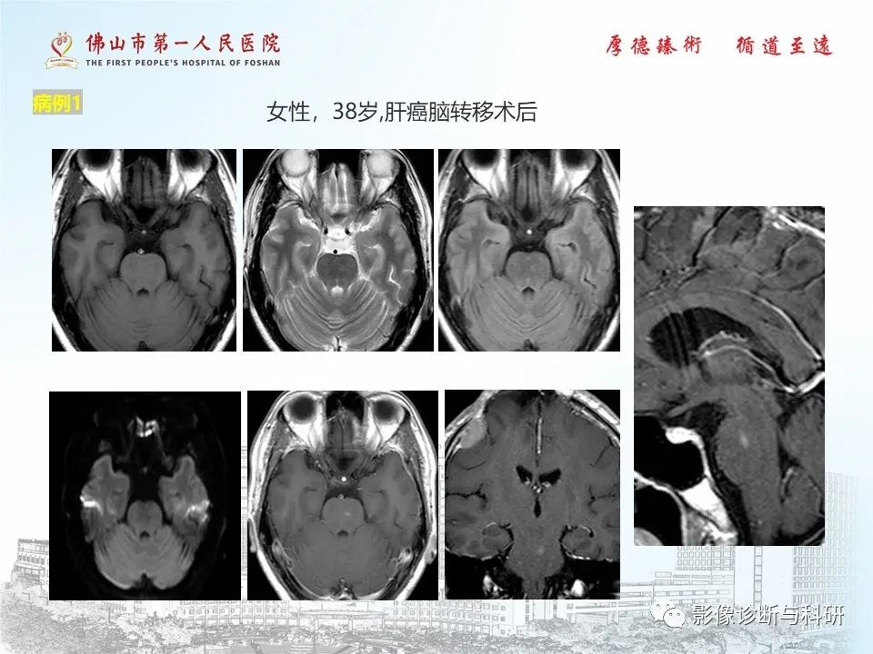 影像PPT - 【PPT】脑血管畸形的影像诊断-39