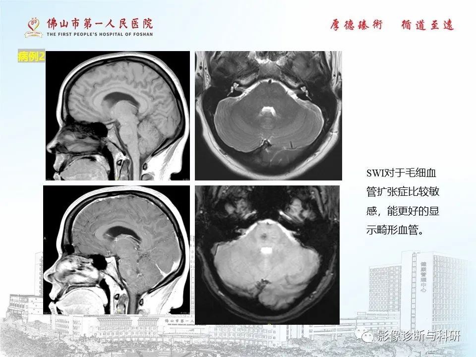 影像PPT - 【PPT】脑血管畸形的影像诊断-40