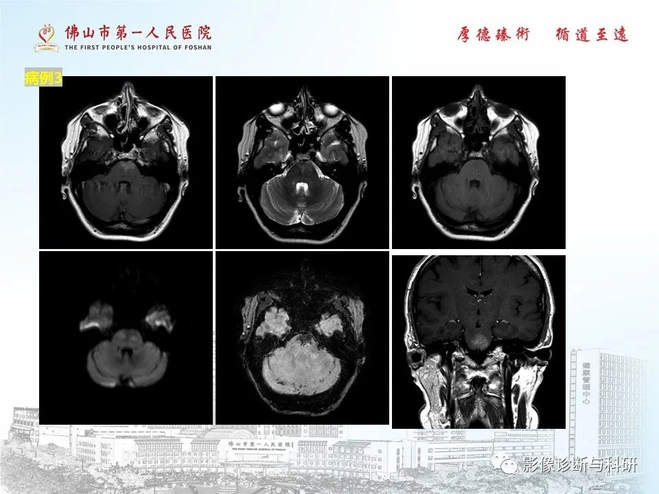 影像PPT - 【PPT】脑血管畸形的影像诊断-41