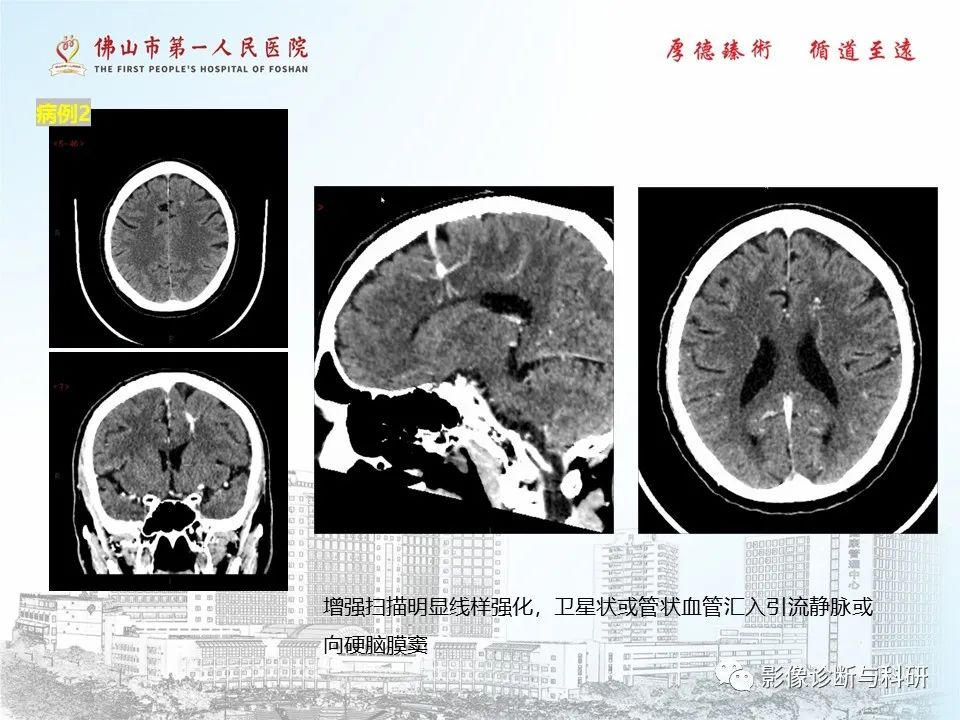 影像PPT - 【PPT】脑血管畸形的影像诊断-44