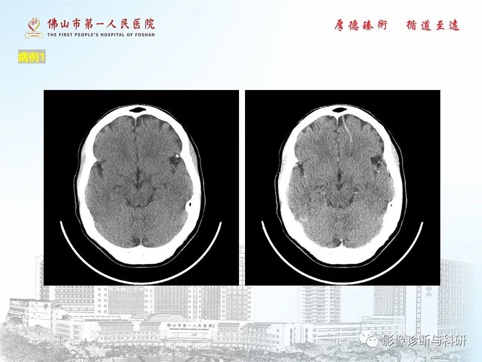 影像PPT - 【PPT】脑血管畸形的影像诊断-43