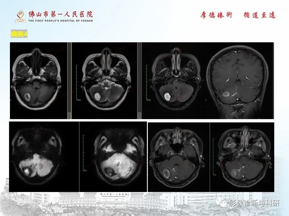 影像PPT - 【PPT】脑血管畸形的影像诊断-46