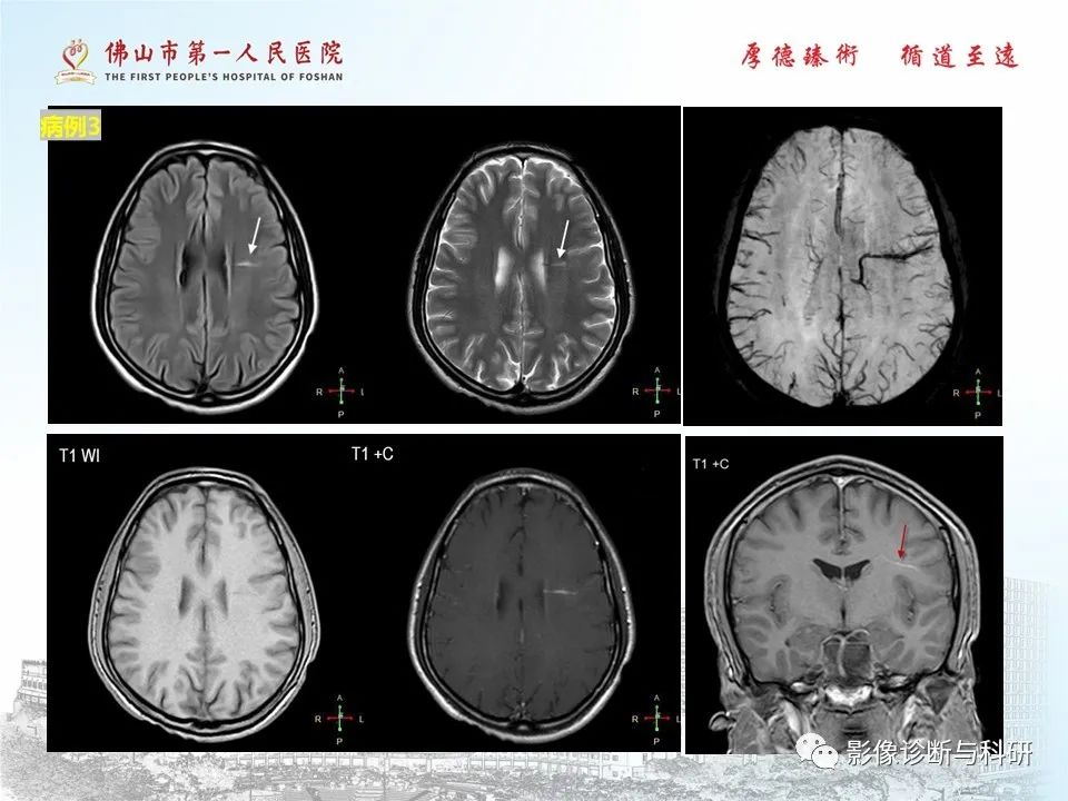影像PPT - 【PPT】脑血管畸形的影像诊断-45