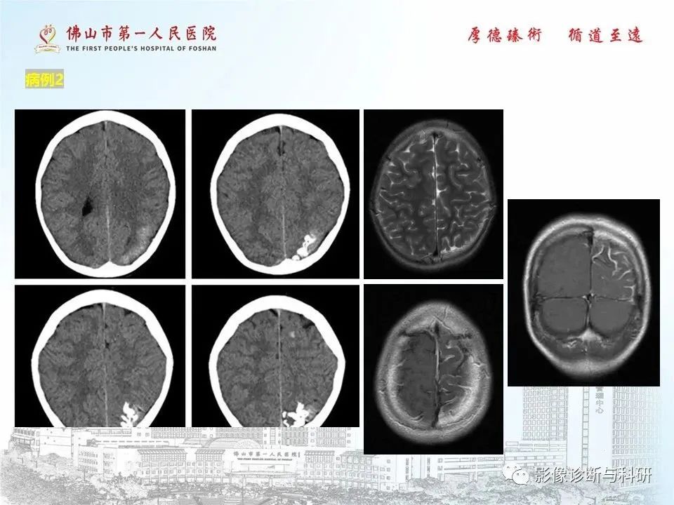 影像PPT - 【PPT】脑血管畸形的影像诊断-50