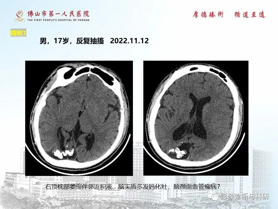 影像PPT - 【PPT】脑血管畸形的影像诊断-49