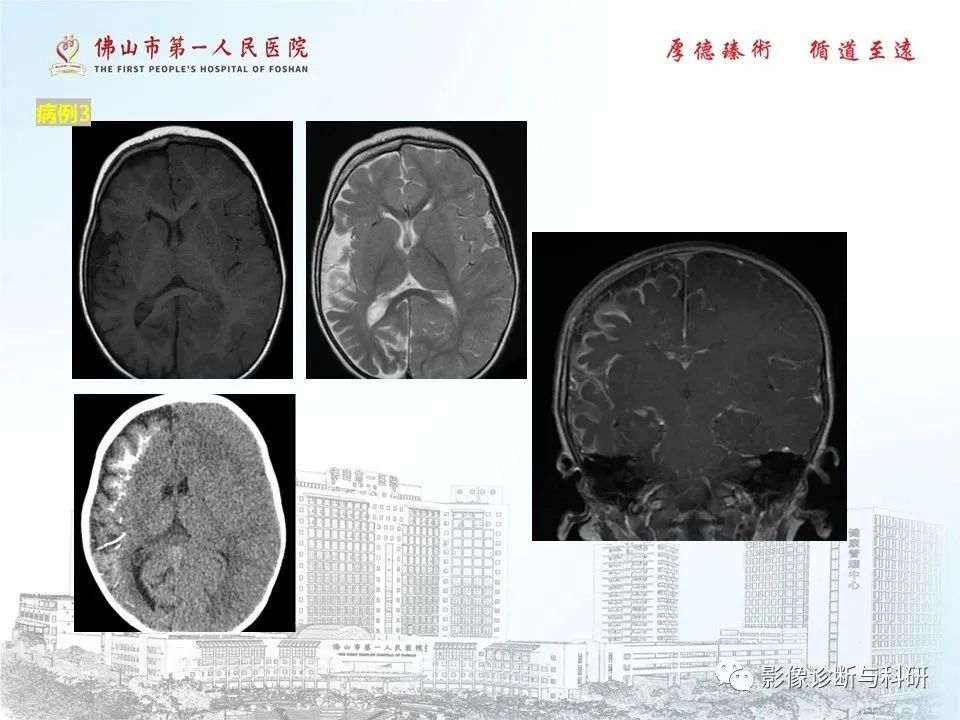 影像PPT - 【PPT】脑血管畸形的影像诊断-51
