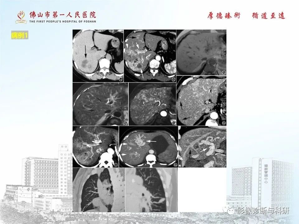 影像PPT - 【PPT】脑血管畸形的影像诊断-54