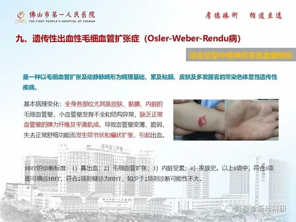 影像PPT - 【PPT】脑血管畸形的影像诊断-52