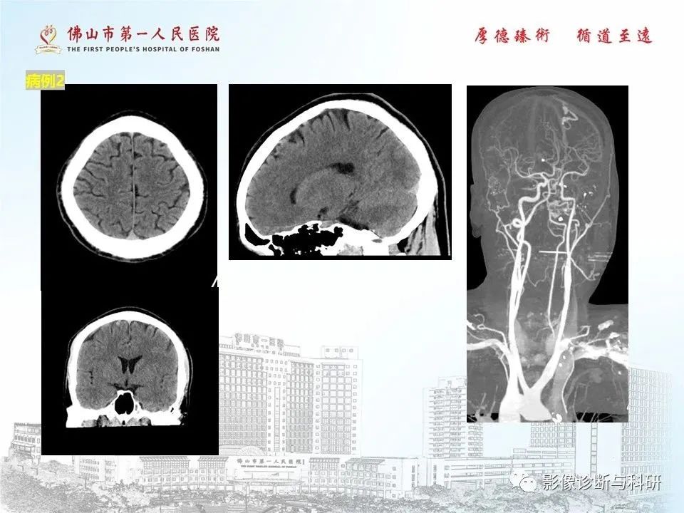 影像PPT - 【PPT】脑血管畸形的影像诊断-55
