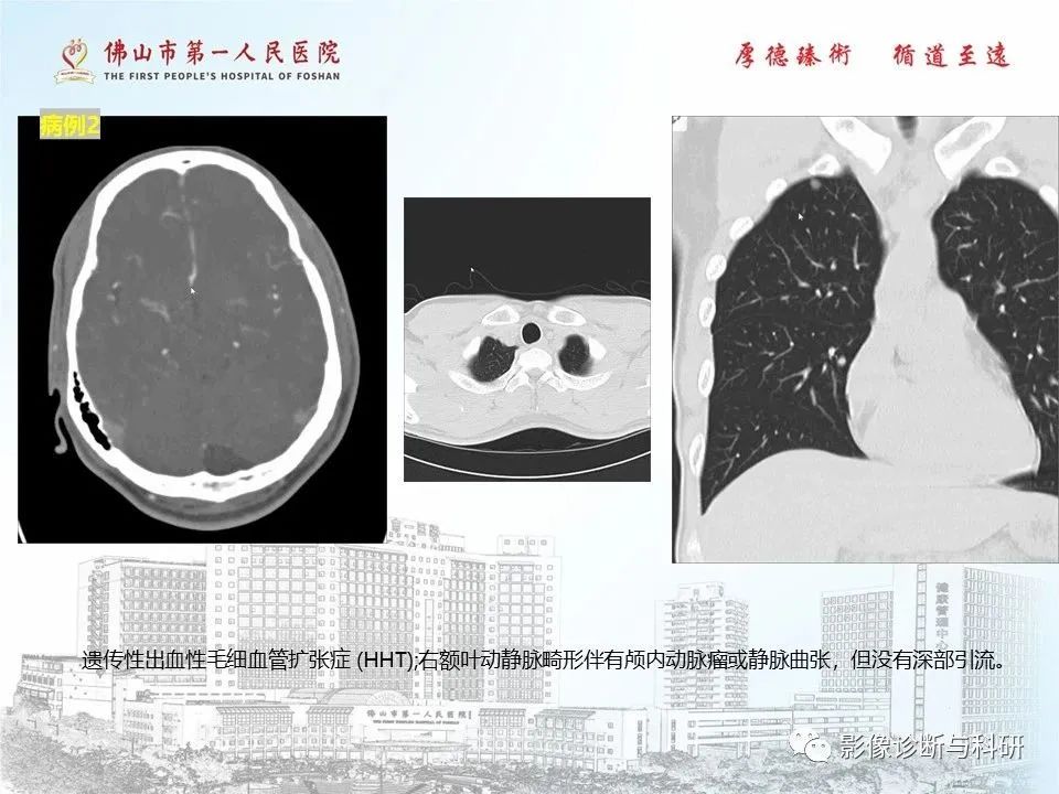 影像PPT - 【PPT】脑血管畸形的影像诊断-56
