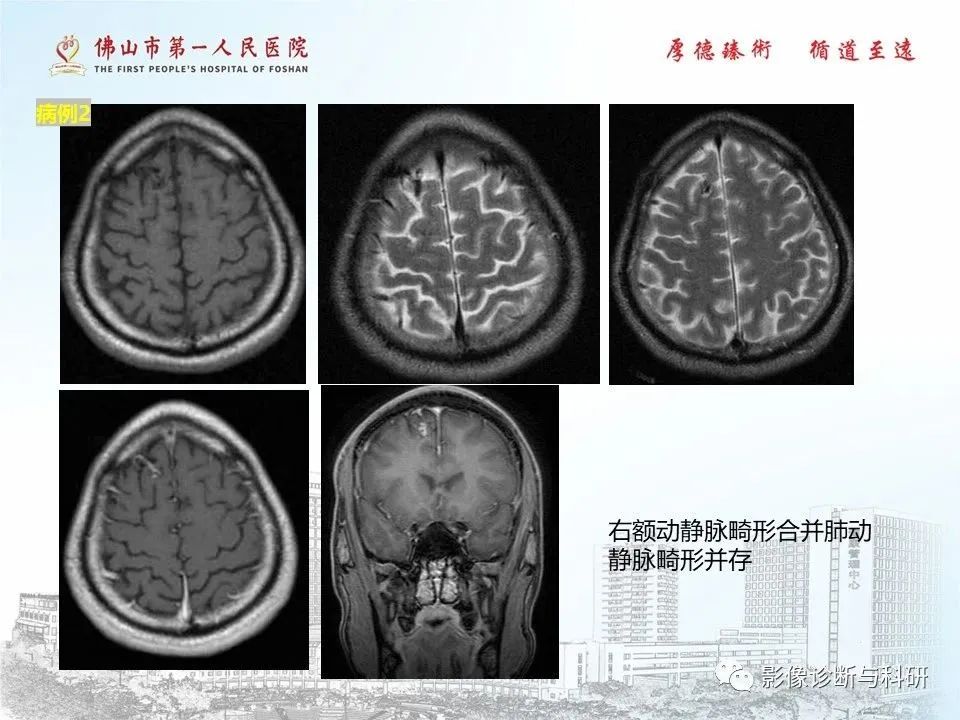 影像PPT - 【PPT】脑血管畸形的影像诊断-57