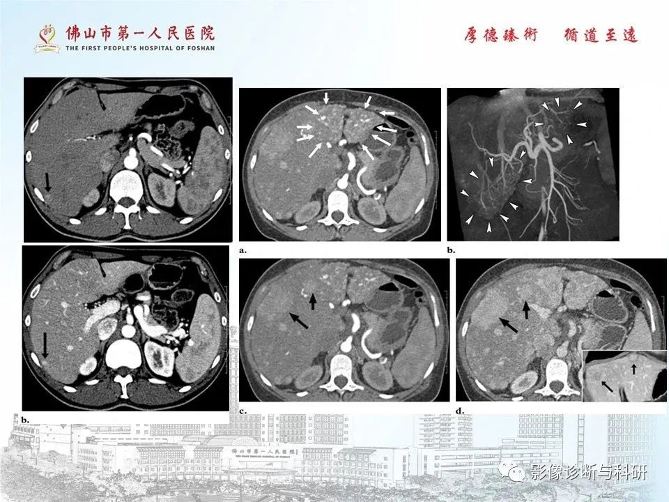 影像PPT - 【PPT】脑血管畸形的影像诊断-58