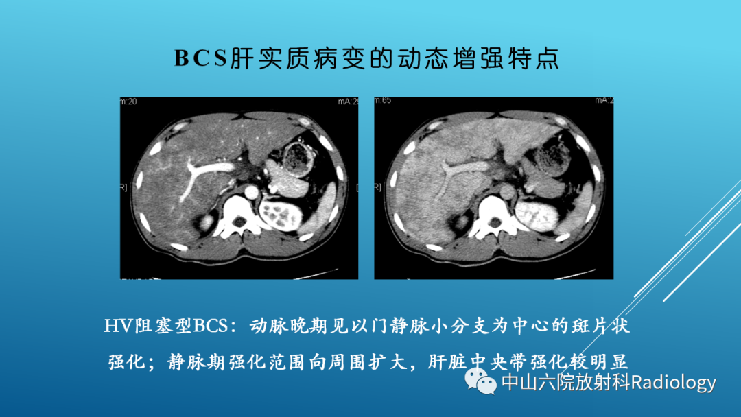 影像PPT - 【PPT】Budd-Chiari Syndrome综合征的影像学表现-8