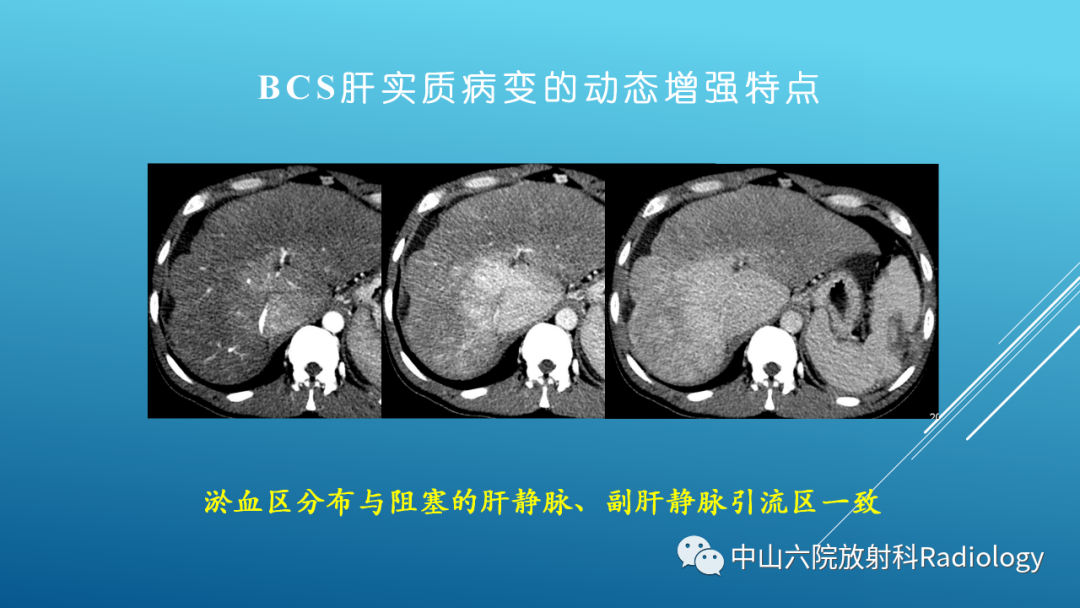 影像PPT - 【PPT】Budd-Chiari Syndrome综合征的影像学表现-9