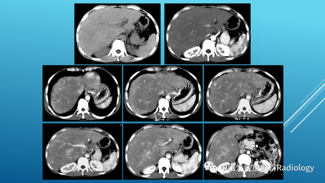 影像PPT - 【PPT】Budd-Chiari Syndrome综合征的影像学表现-10