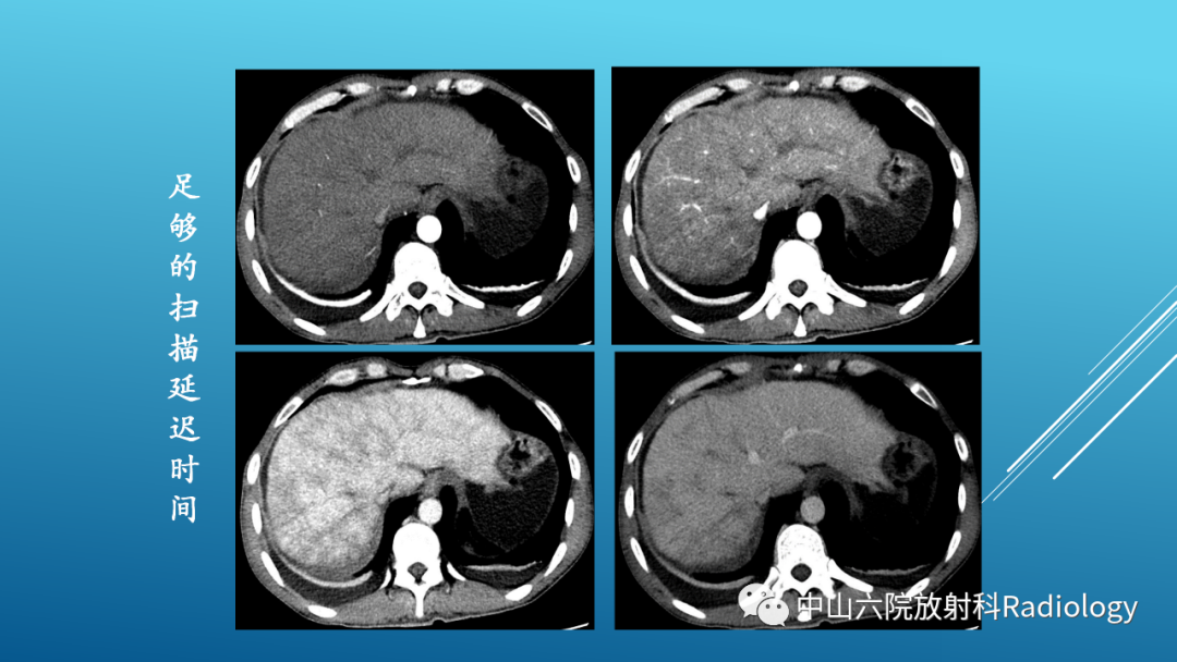 影像PPT - 【PPT】Budd-Chiari Syndrome综合征的影像学表现-11