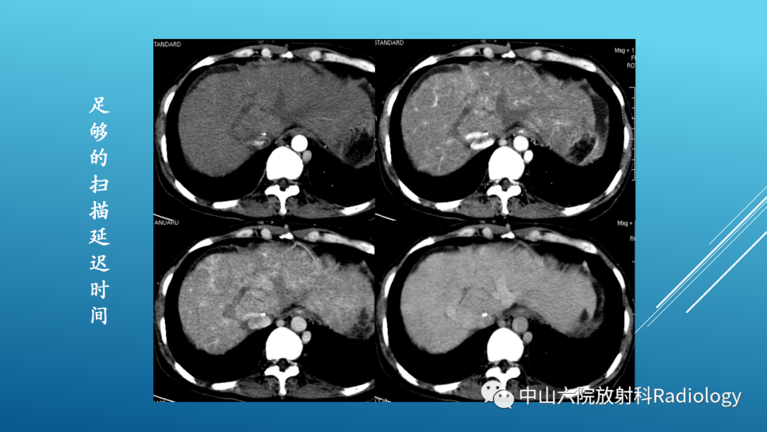 影像PPT - 【PPT】Budd-Chiari Syndrome综合征的影像学表现-12