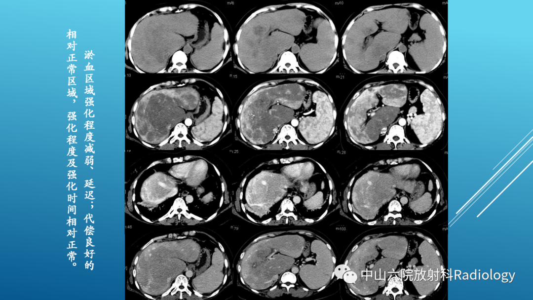 影像PPT - 【PPT】Budd-Chiari Syndrome综合征的影像学表现-13