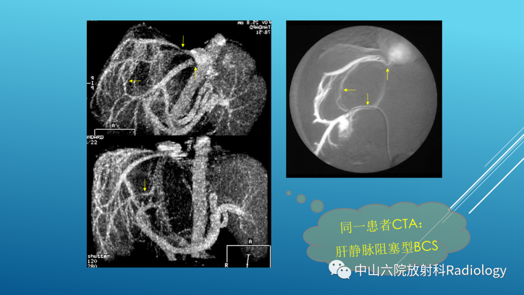 影像PPT - 【PPT】Budd-Chiari Syndrome综合征的影像学表现-14