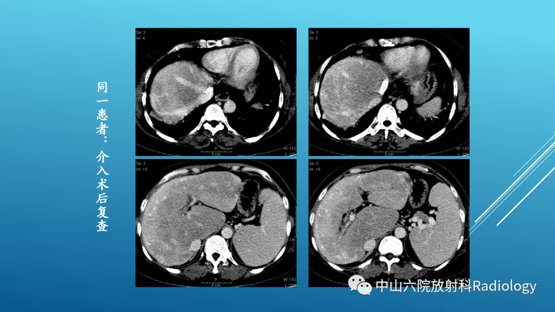 影像PPT - 【PPT】Budd-Chiari Syndrome综合征的影像学表现-15