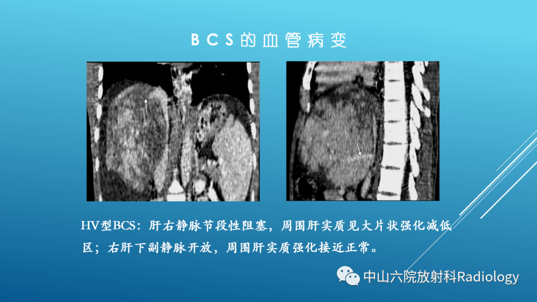 影像PPT - 【PPT】Budd-Chiari Syndrome综合征的影像学表现-16
