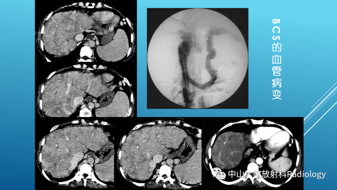 影像PPT - 【PPT】Budd-Chiari Syndrome综合征的影像学表现-17