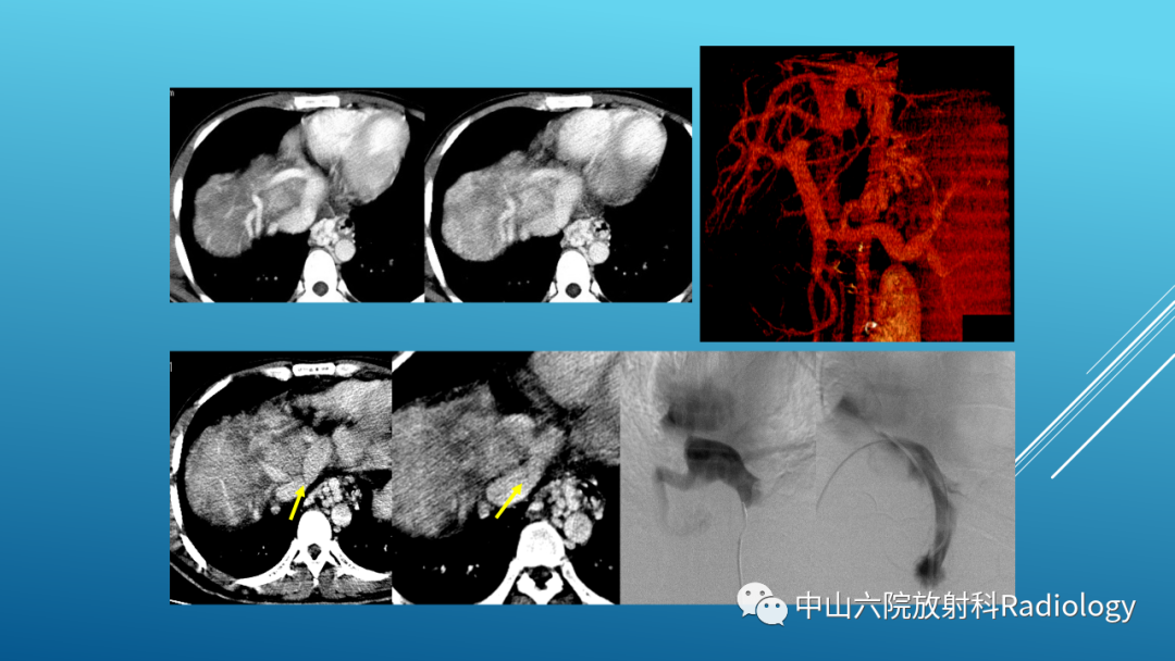 影像PPT - 【PPT】Budd-Chiari Syndrome综合征的影像学表现-18
