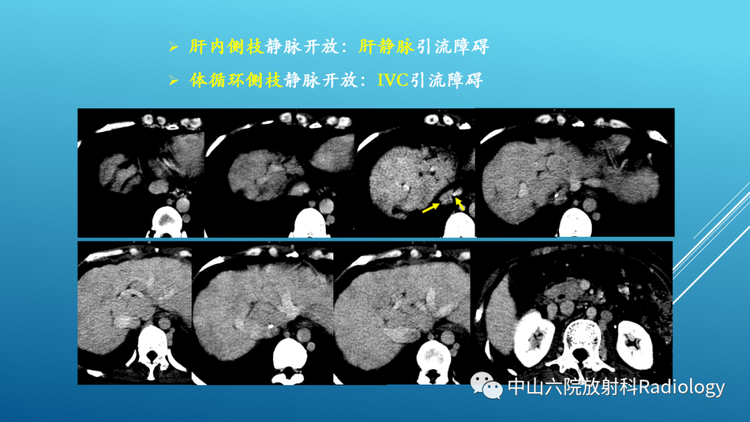 影像PPT - 【PPT】Budd-Chiari Syndrome综合征的影像学表现-19