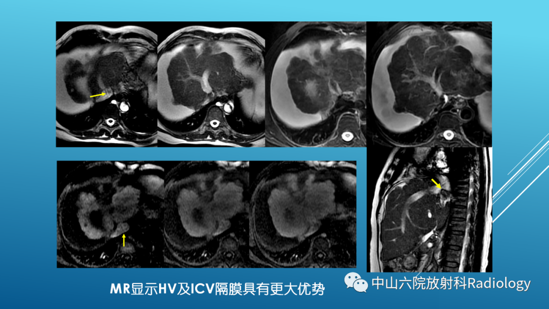 影像PPT - 【PPT】Budd-Chiari Syndrome综合征的影像学表现-20