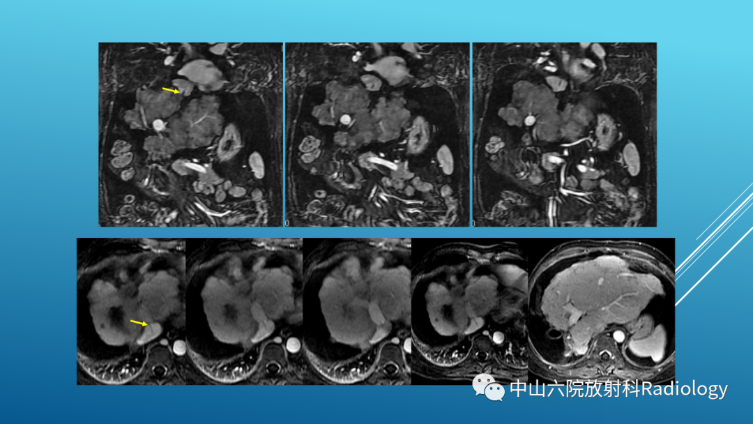 影像PPT - 【PPT】Budd-Chiari Syndrome综合征的影像学表现-21