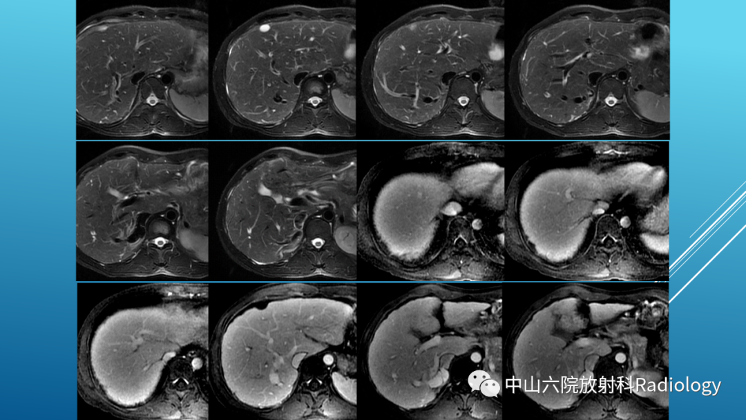 影像PPT - 【PPT】Budd-Chiari Syndrome综合征的影像学表现-22