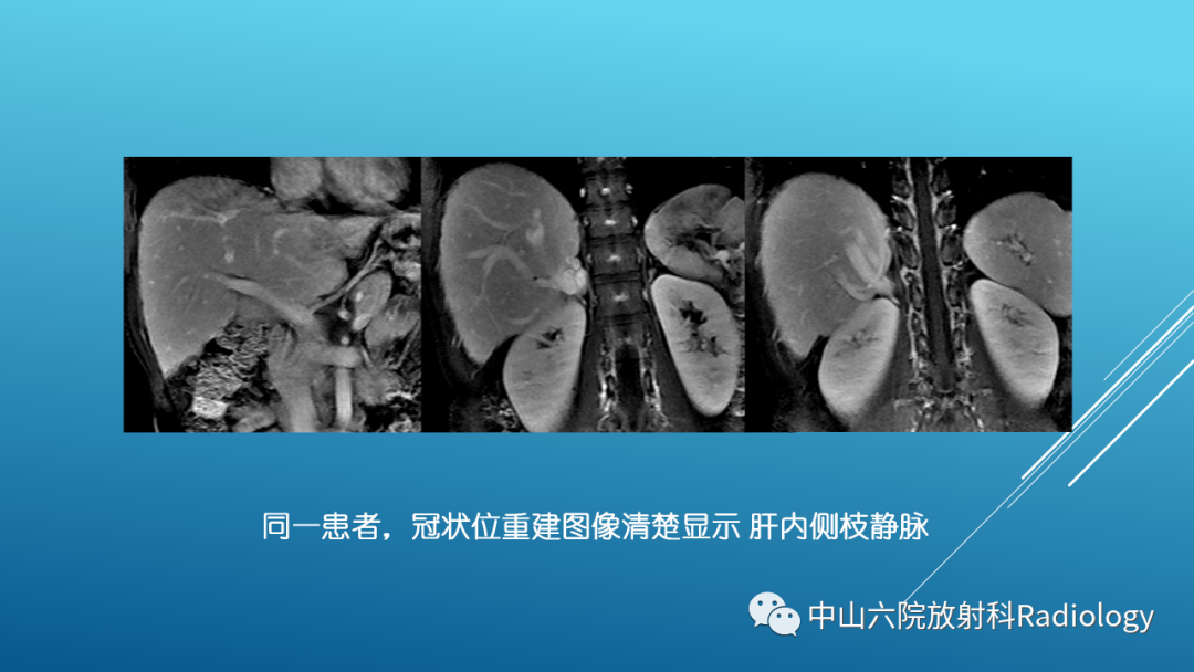 影像PPT - 【PPT】Budd-Chiari Syndrome综合征的影像学表现-23