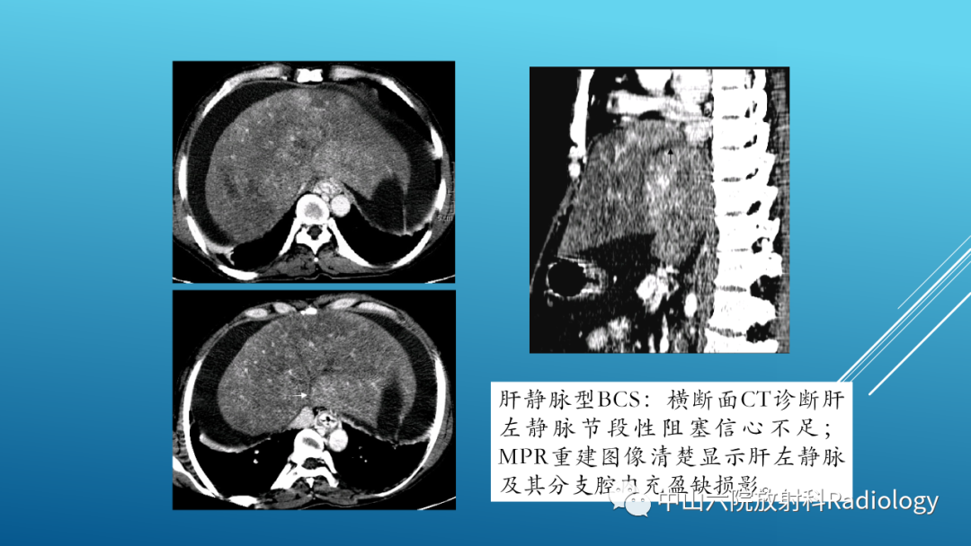 影像PPT - 【PPT】Budd-Chiari Syndrome综合征的影像学表现-25