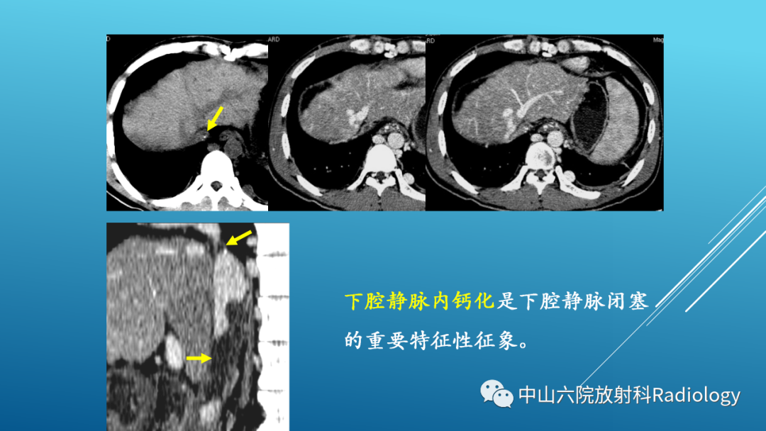 影像PPT - 【PPT】Budd-Chiari Syndrome综合征的影像学表现-26