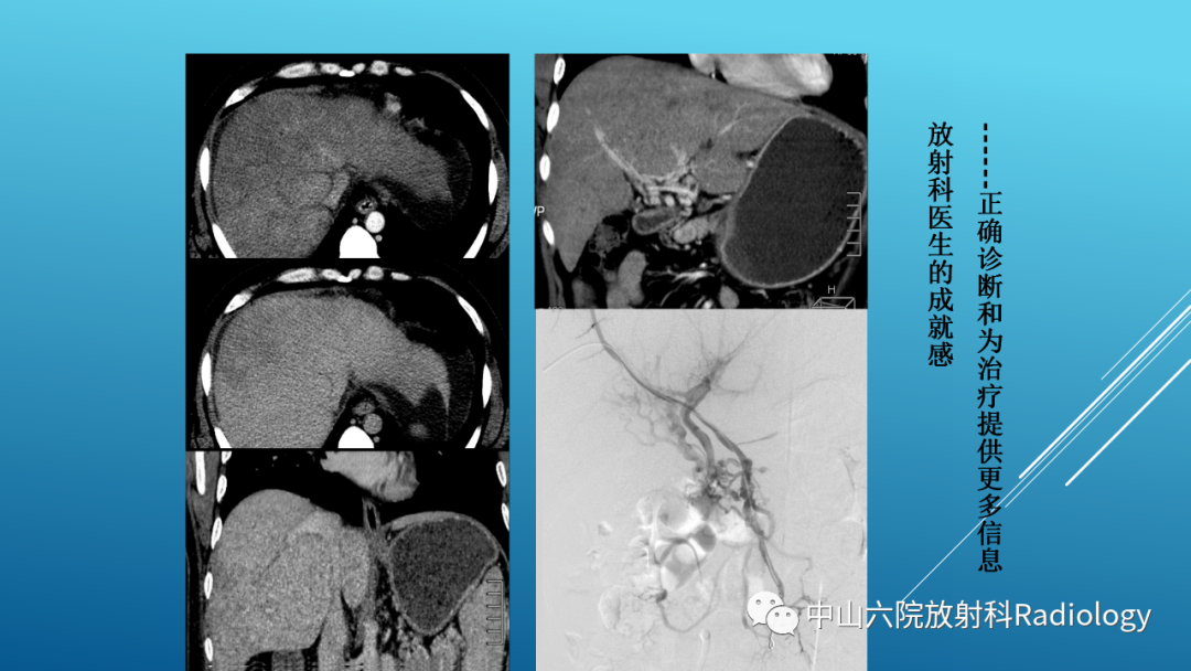 影像PPT - 【PPT】Budd-Chiari Syndrome综合征的影像学表现-27