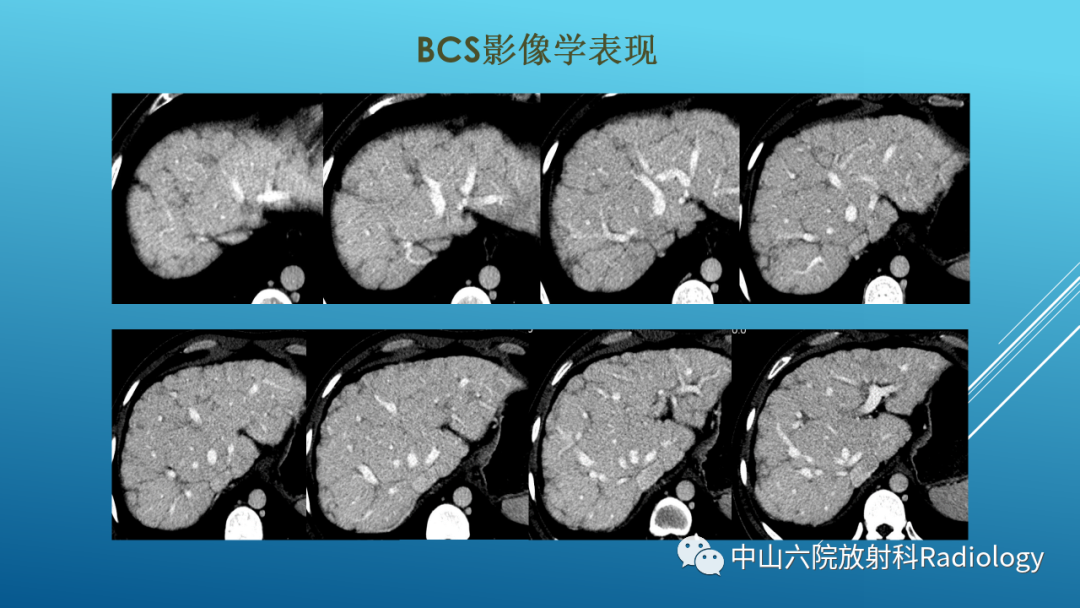 影像PPT - 【PPT】Budd-Chiari Syndrome综合征的影像学表现-28