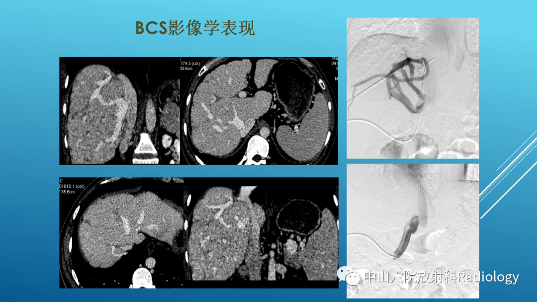 影像PPT - 【PPT】Budd-Chiari Syndrome综合征的影像学表现-29