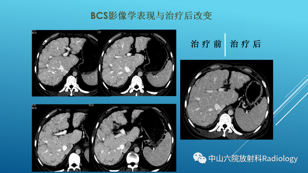 影像PPT - 【PPT】Budd-Chiari Syndrome综合征的影像学表现-30