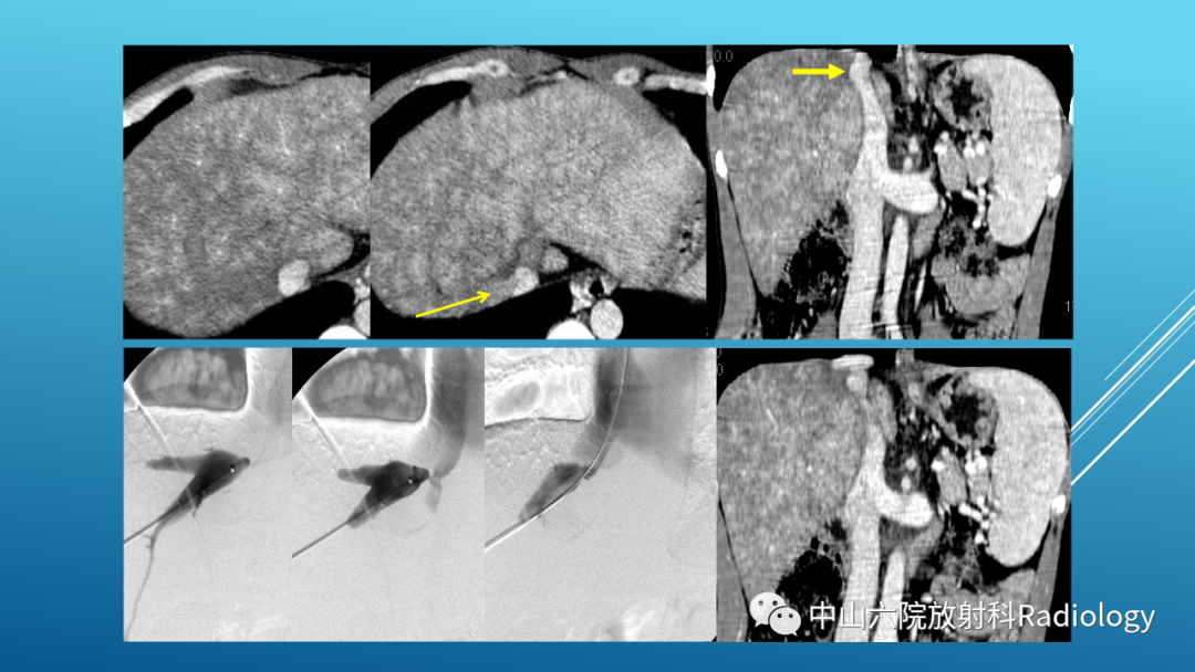影像PPT - 【PPT】Budd-Chiari Syndrome综合征的影像学表现-31