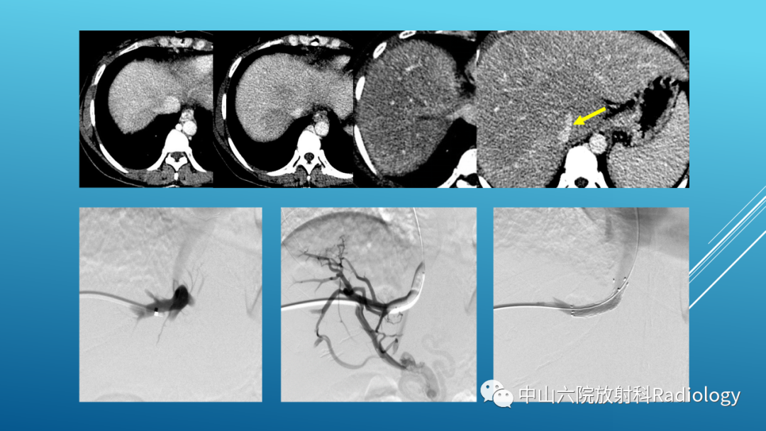 影像PPT - 【PPT】Budd-Chiari Syndrome综合征的影像学表现-32