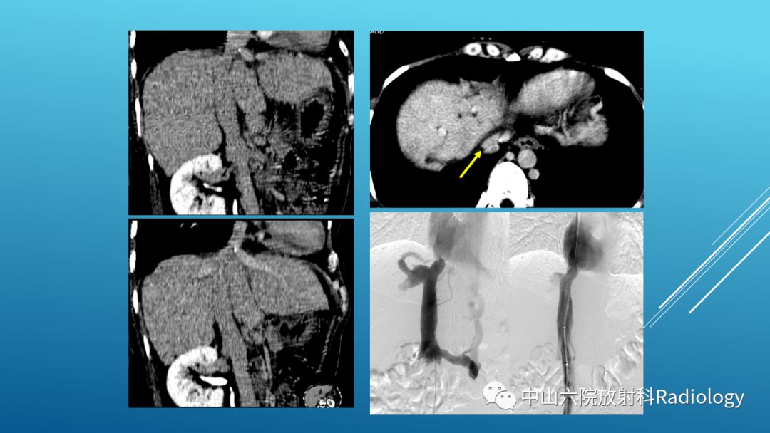影像PPT - 【PPT】Budd-Chiari Syndrome综合征的影像学表现-33