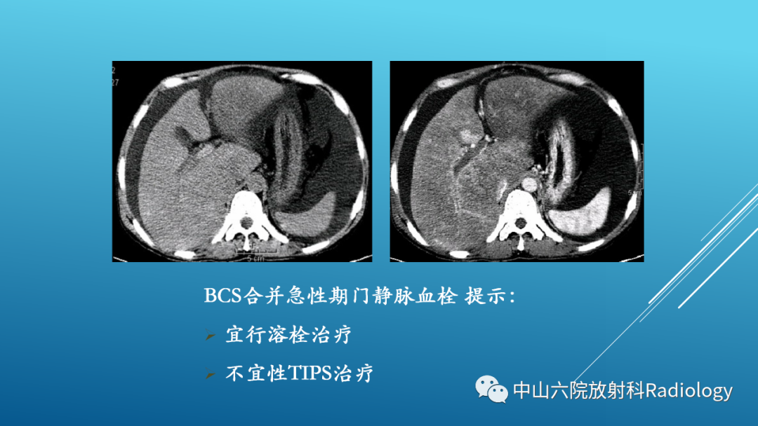 影像PPT - 【PPT】Budd-Chiari Syndrome综合征的影像学表现-34