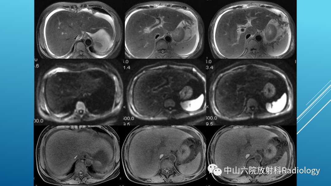影像PPT - 【PPT】Budd-Chiari Syndrome综合征的影像学表现-38