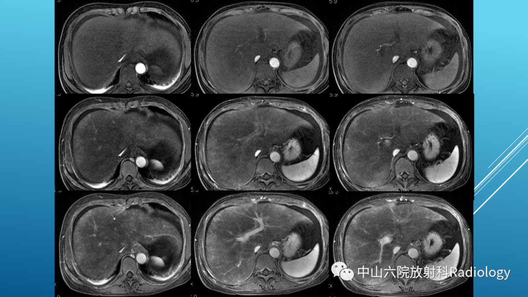 影像PPT - 【PPT】Budd-Chiari Syndrome综合征的影像学表现-39