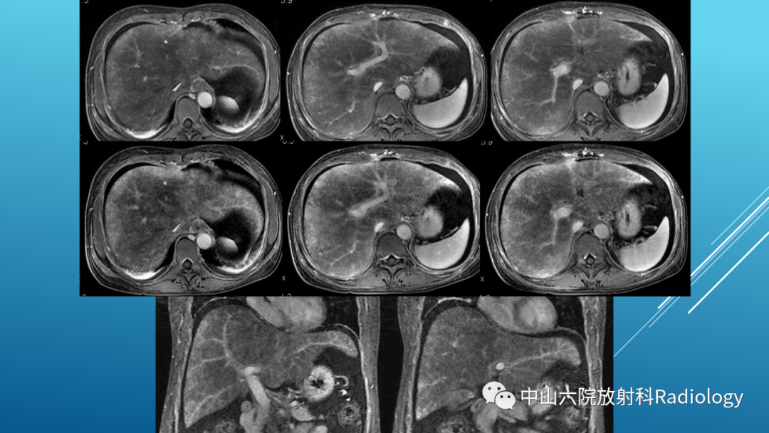 影像PPT - 【PPT】Budd-Chiari Syndrome综合征的影像学表现-40