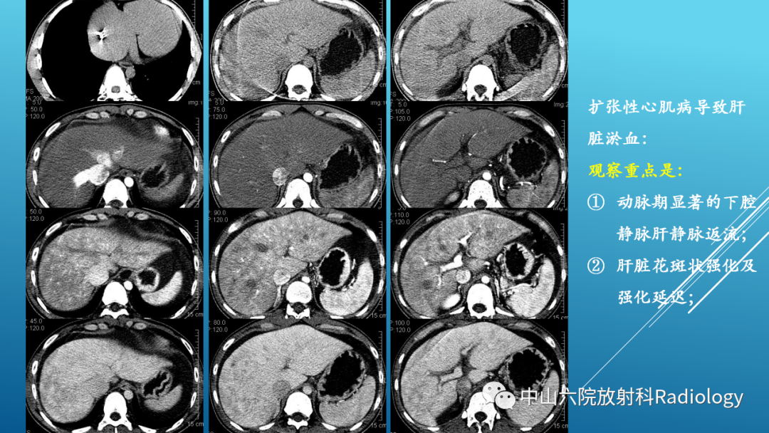 影像PPT - 【PPT】Budd-Chiari Syndrome综合征的影像学表现-42