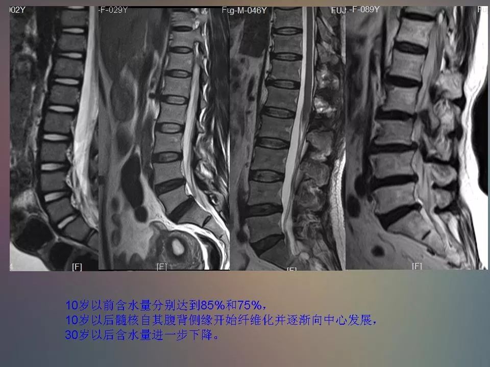 影像PPT - 【PPT】腰椎退行性变腰痛的MR诊断-8