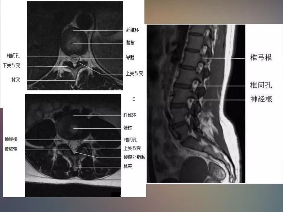 影像PPT - 【PPT】腰椎退行性变腰痛的MR诊断-9