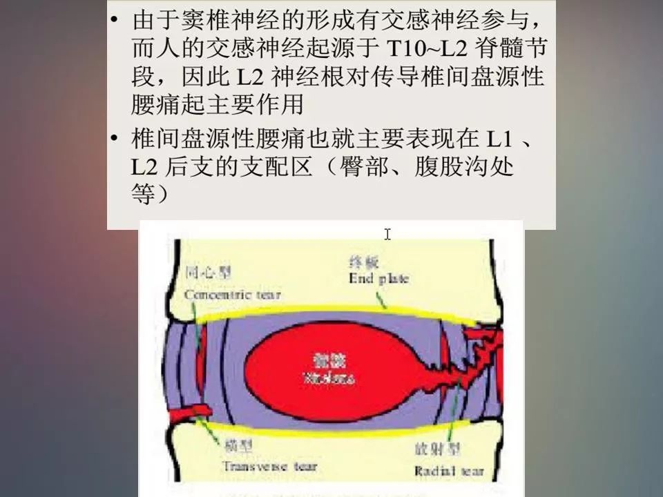 影像PPT - 【PPT】腰椎退行性变腰痛的MR诊断-13