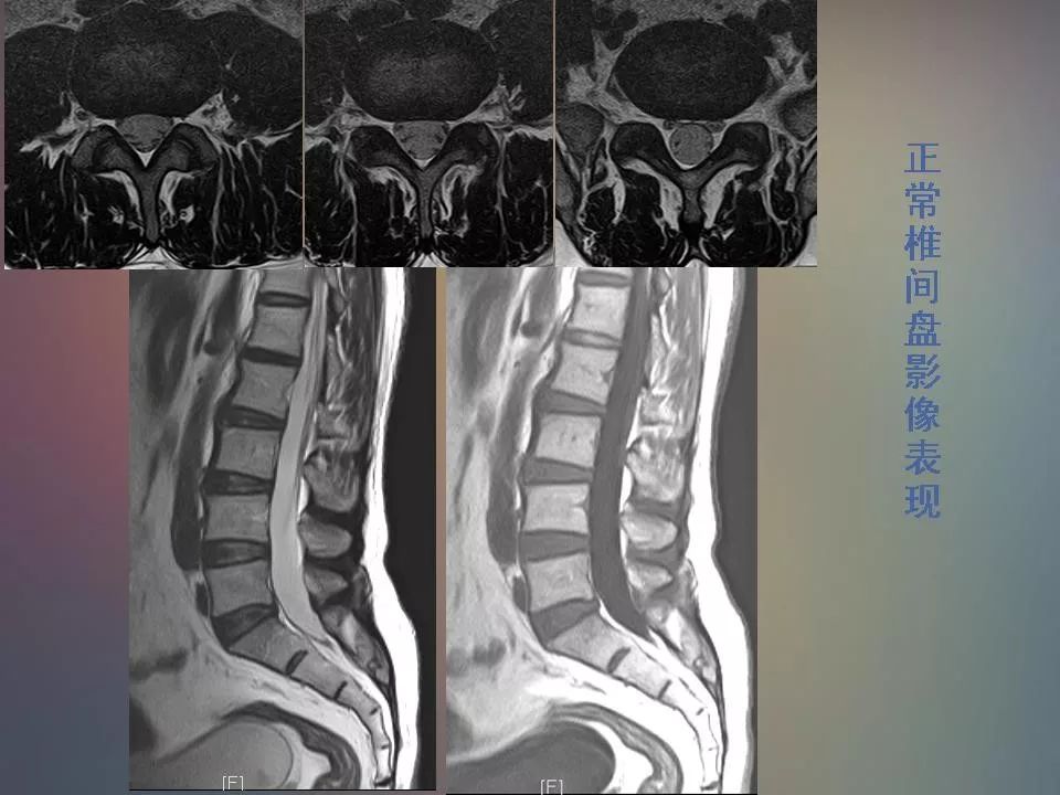 影像PPT - 【PPT】腰椎退行性变腰痛的MR诊断-26